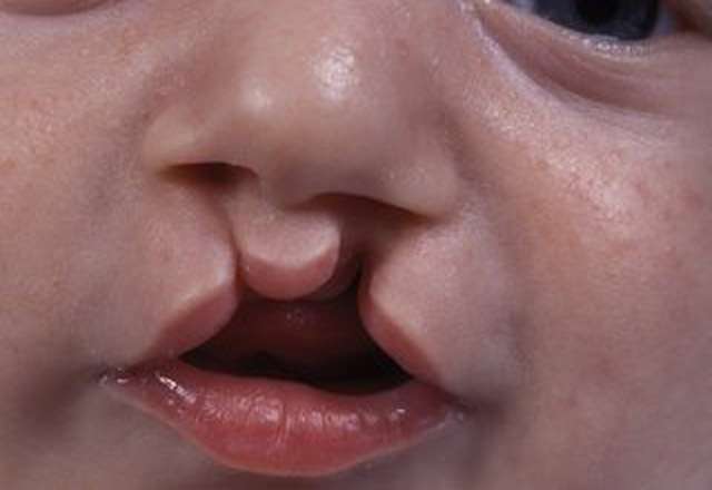 cleft plate treatment in Lahore