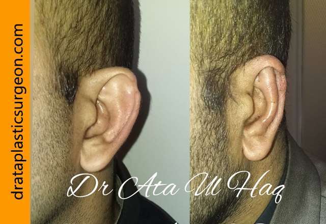 ear reshaping surgery in lahore