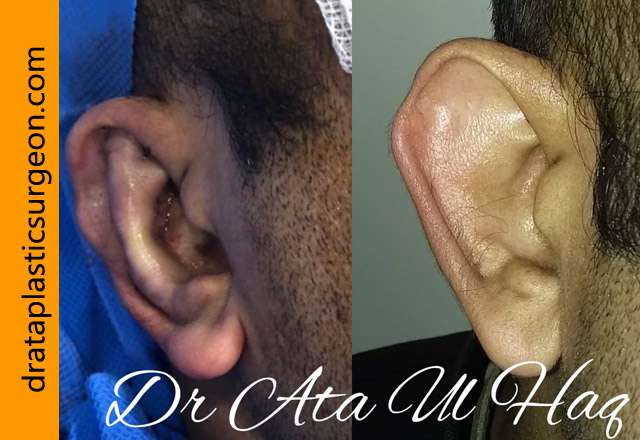 Ear Reshaping Surgery