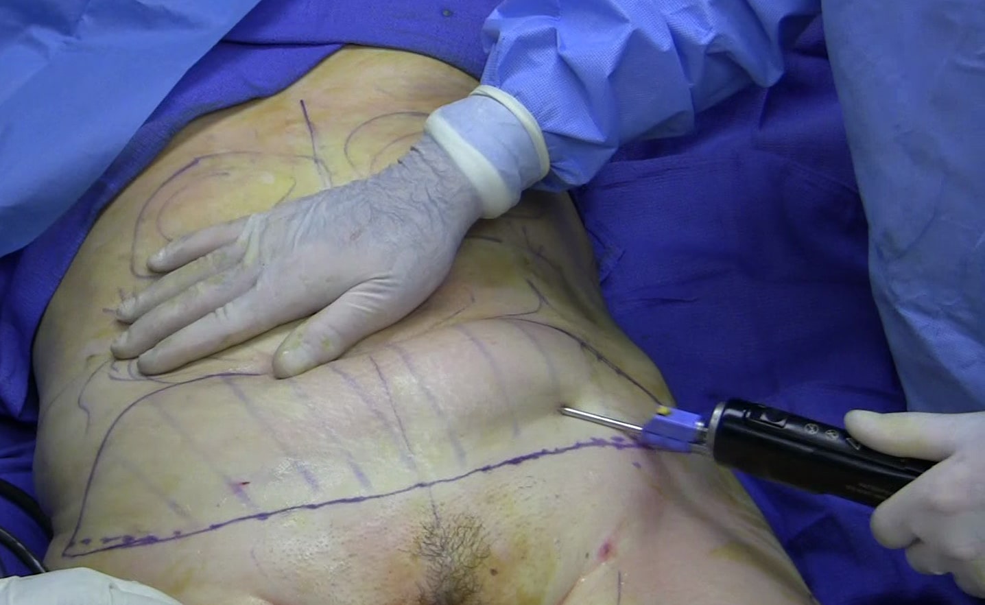 back-bra-fat-liposuction-karachi-pakistan - Cosmetic Surgeon