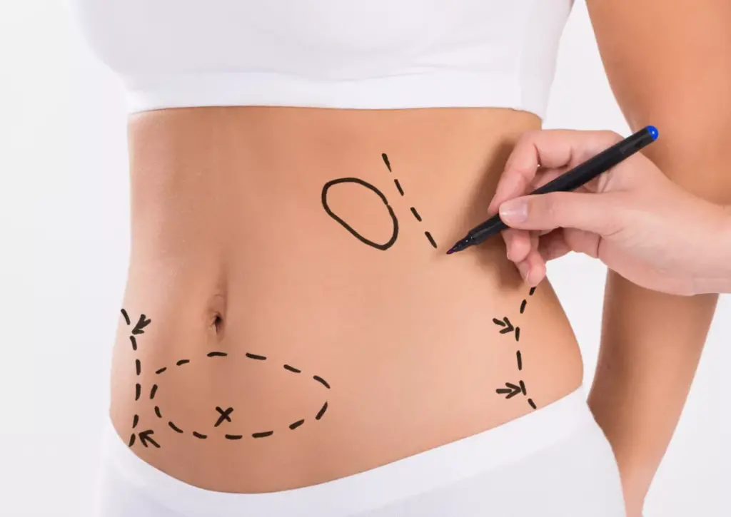 Understanding Liposuction: A Comprehensive Guide