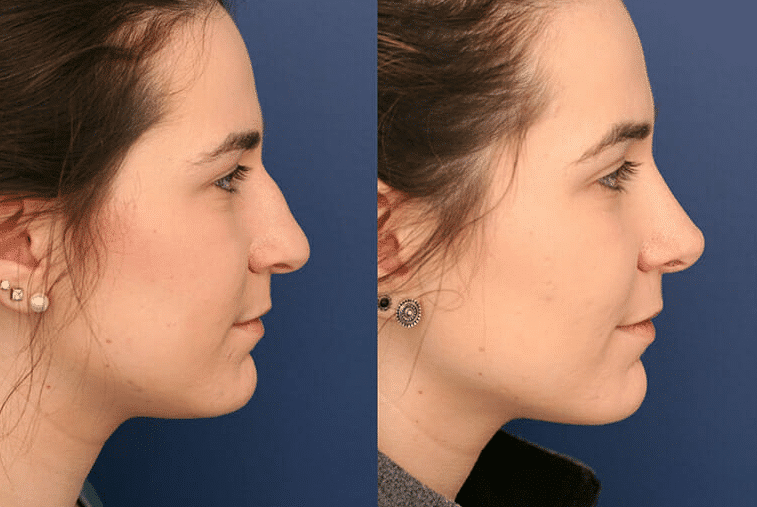An Extensive Discussion of the Rhinoplasty Procedure