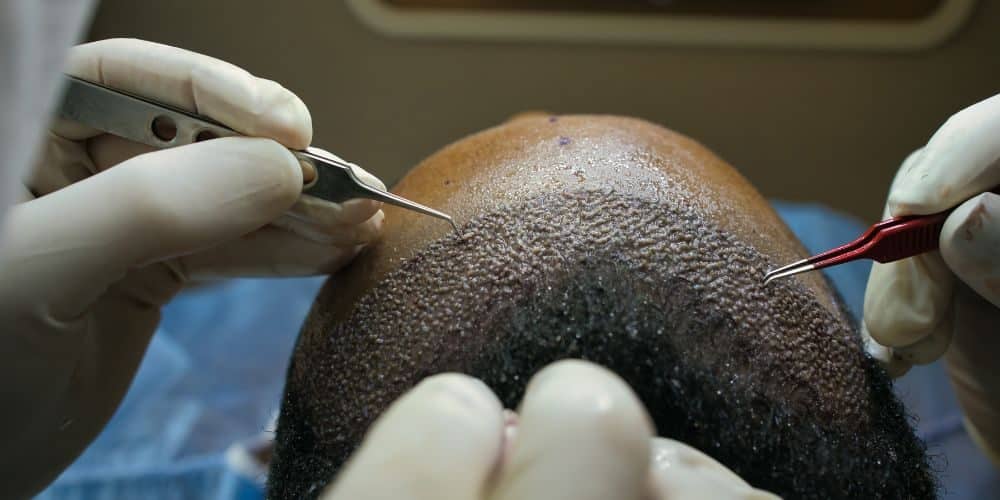Unlocking Confidence: A Comprehensive Guide to Hair Transplant Solutions