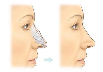Rhinoplasty in Lahore: Unveiling the Art and Science of Nose Reshaping