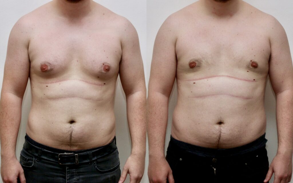 Knowing Gynecomastia: Is It the Right Choice for You?