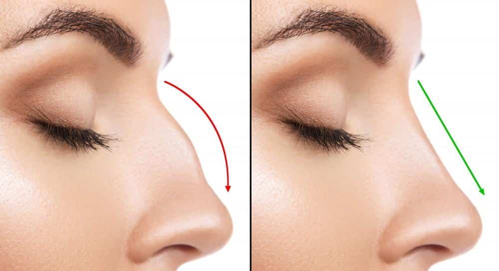 The Complete Guide to Rhinoplasty: Denying Myths and Revealing Facts