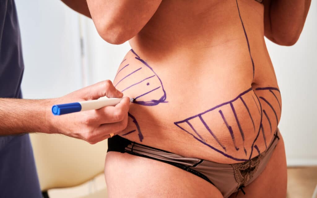 Achieve Your Body Goals: Is Liposuction the Key?