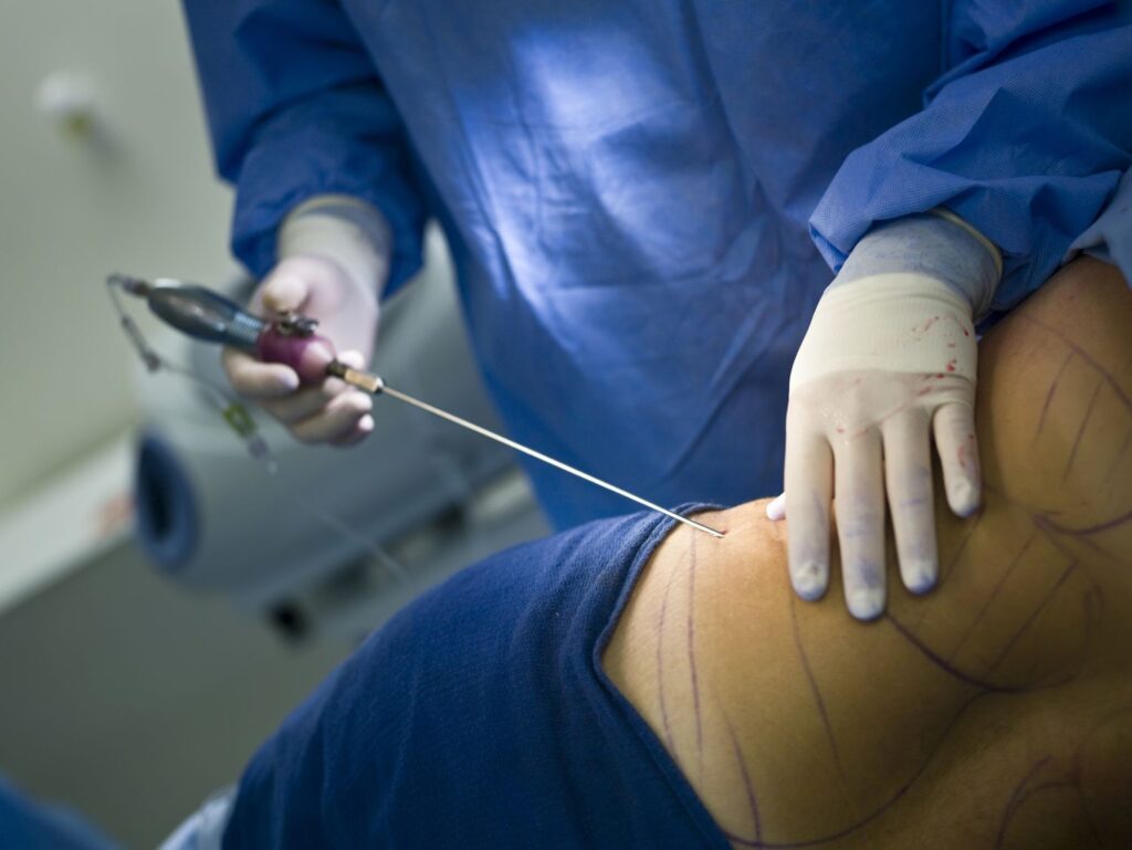 Is Liposuction Right for You