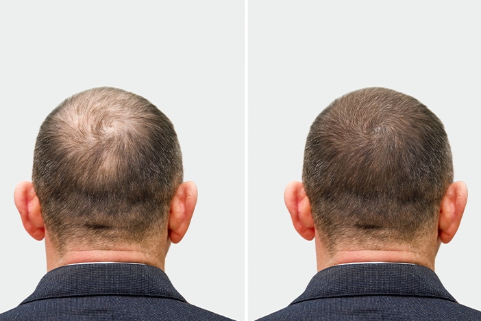 Hair Transplant