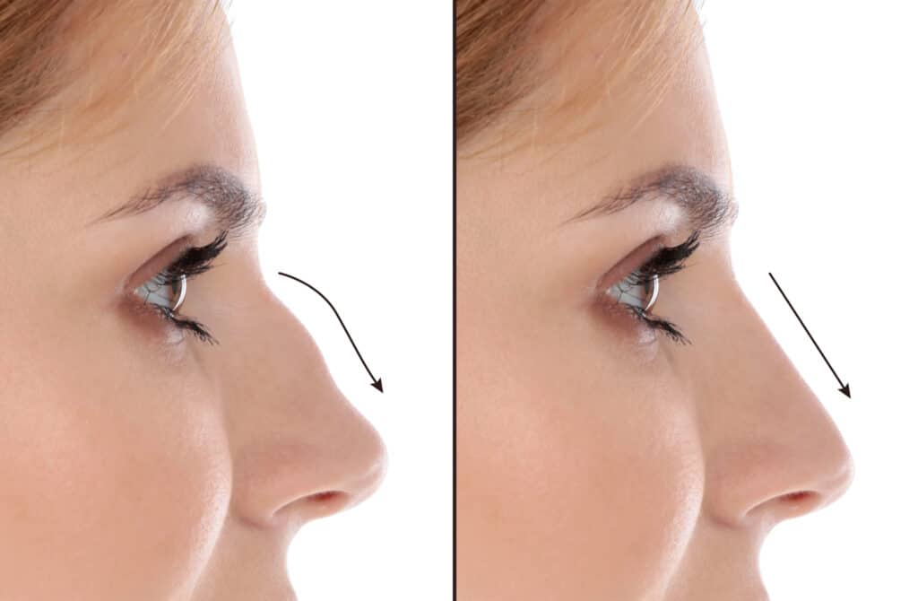 What Are the Benefits of Rhinoplasty & Its Transformative Power