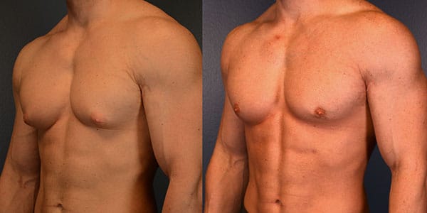 What to Expect During Gynecomastia Treatment - Process Explained