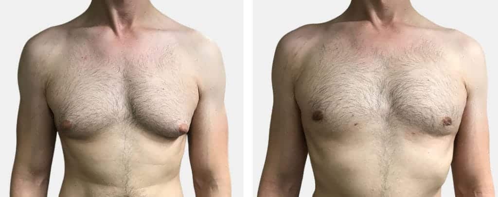 Gynecomastia Surgery Options and Recovery in Pakistan - A Comprehensive Guide (2024 Update)