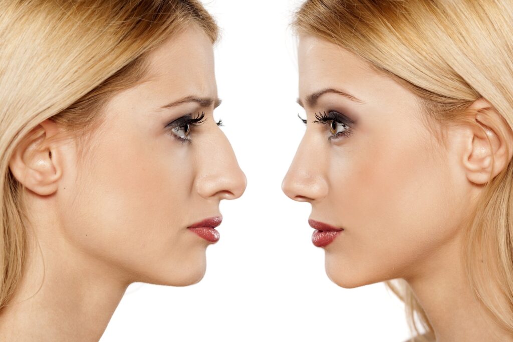 Beyond Appearance - Exploring the Emotional Impact of Rhinoplasty in Pakistan