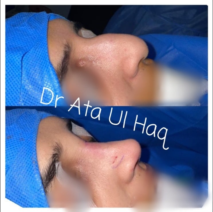skin-grafting