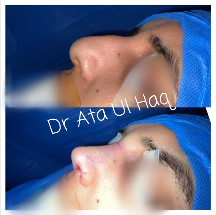 skin-grafting