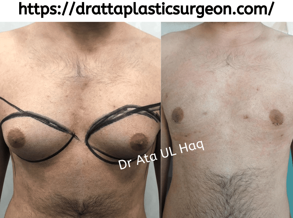 gynecomastia-treatment-without-surgery