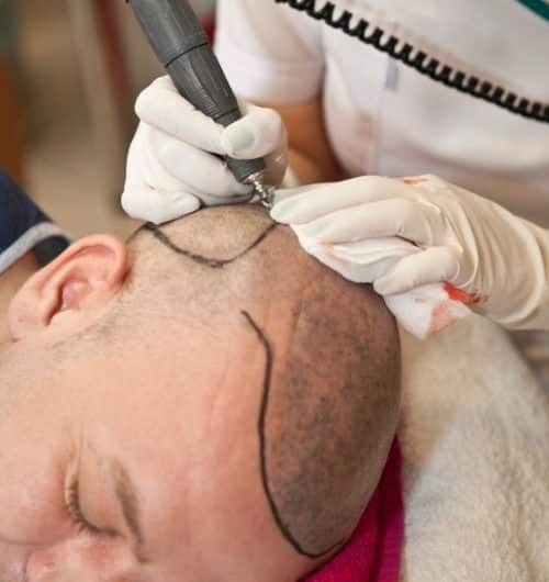 is-hair-transplant-halal