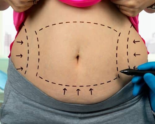 fat-removal-surgery-pakistan