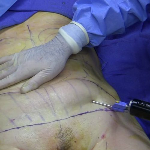 liposuction-surgery