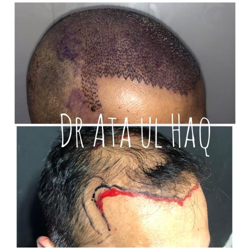 Hair Transplants (1)