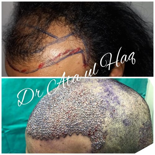 Hair Transplants (10)