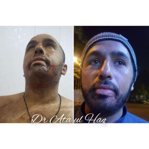 Hair Transplants (11)