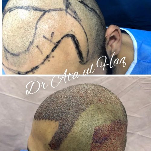 Hair Transplants (13)