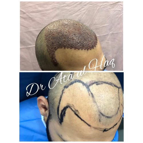 Hair Transplants (14)