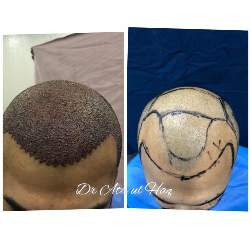 Hair Transplants (15)