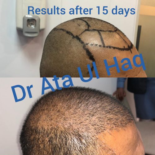 Hair Transplants (16)
