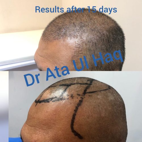 Hair Transplants (17)