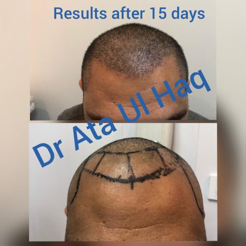 Hair Transplants (18)