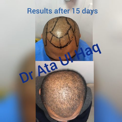 Hair Transplants (19)