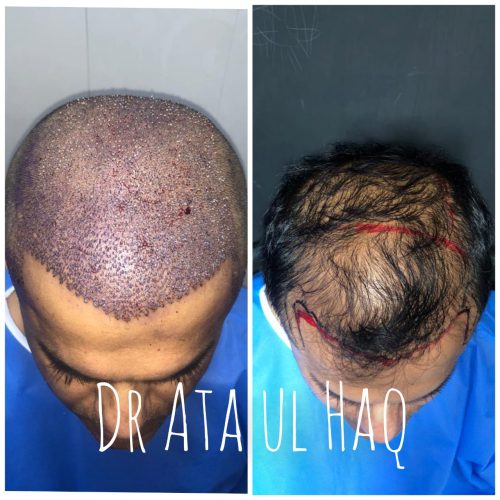hair-transplant-in-lahore