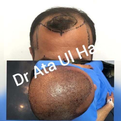 Hair Transplants (20)