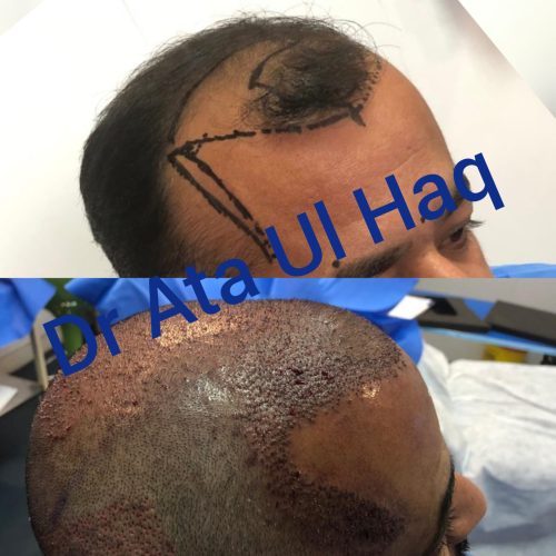 Hair Transplants (21)
