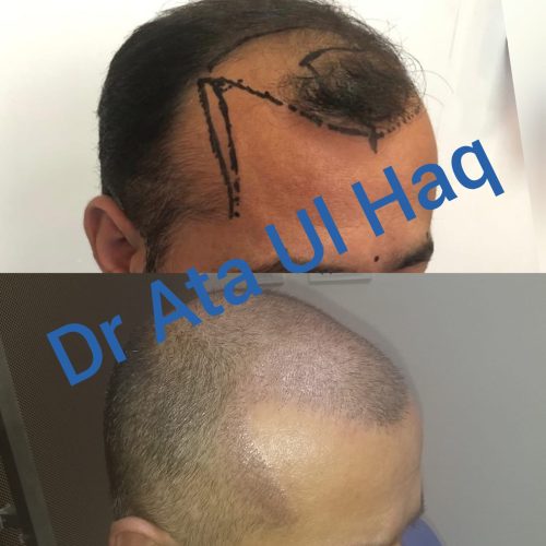 Hair Transplants (22)