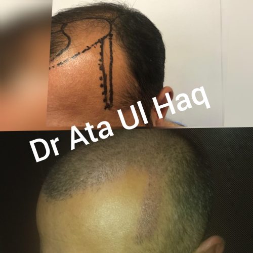 Hair Transplants (23)
