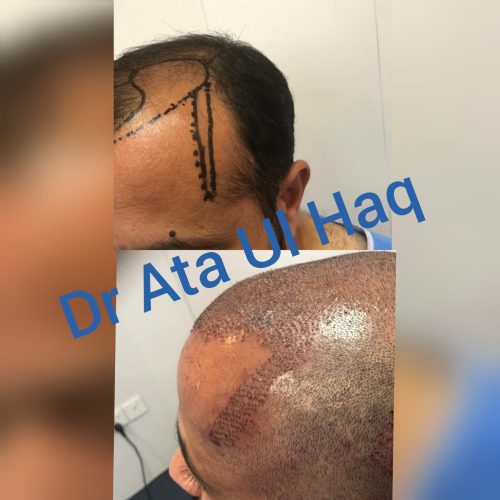 Hair Transplants (24)