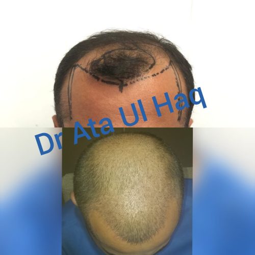 Hair Transplants (25)