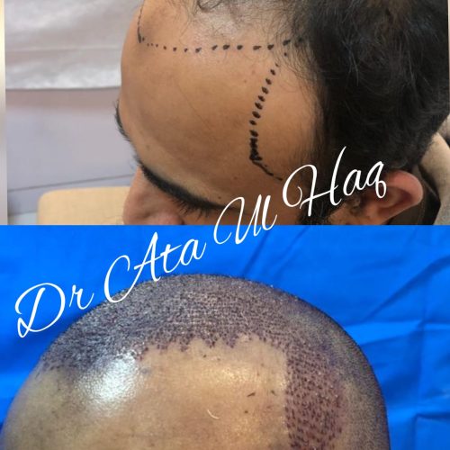 Hair Transplants (26)