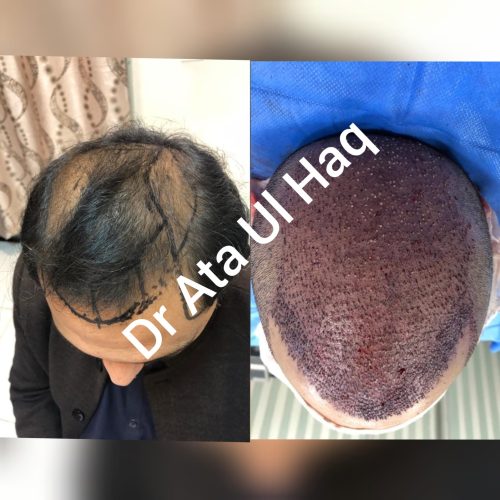 Hair Transplants (27)
