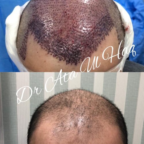 Hair Transplants (28)
