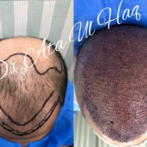 hair-transplant-in-lahore
