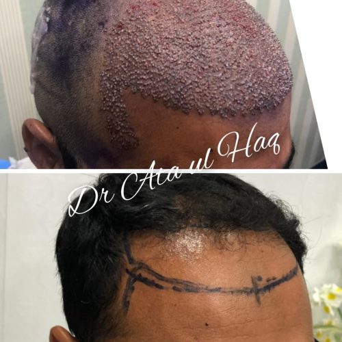 Hair Transplants (3)