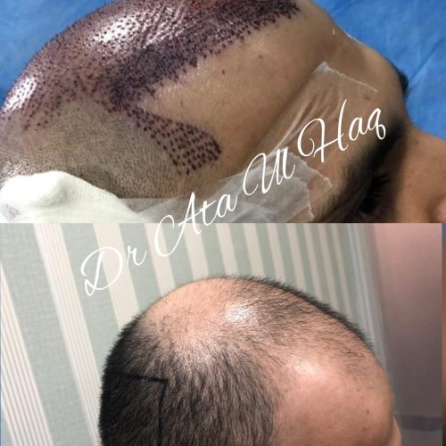 Hair Transplants (30)