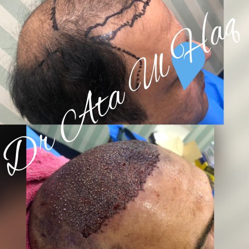 Hair Transplants (31)