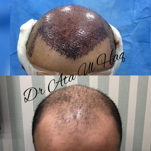 Hair Transplants (32)