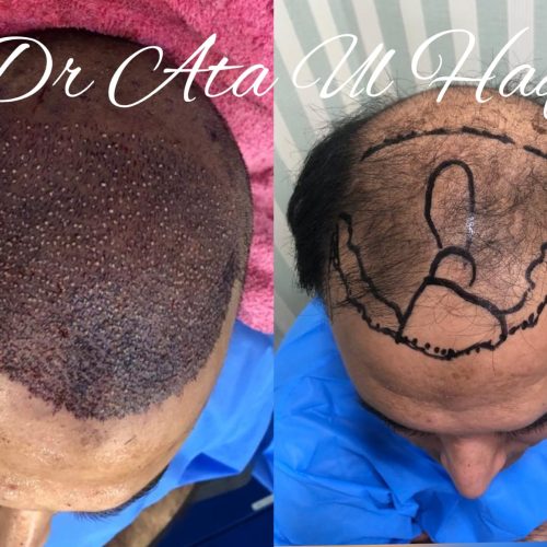 Hair Transplants (33)