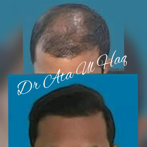 Hair Transplants (34)